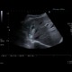 Liver hematoma: US - Ultrasound
